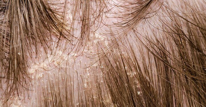 Managing Scalp Irritation and Eczema Between Cuts 1 scalp-eczema